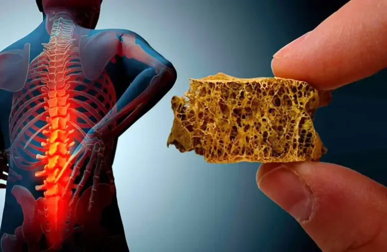 پوکی+استخوان