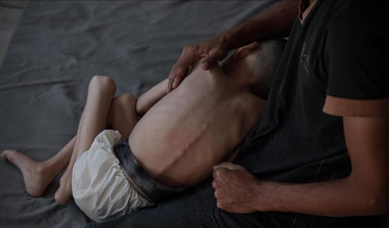 Acute hunger in Gaza