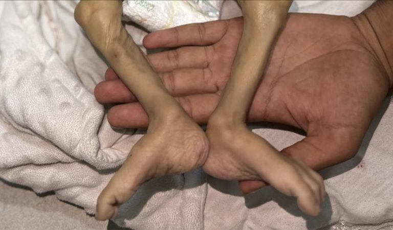 Severe hunger in Gaza